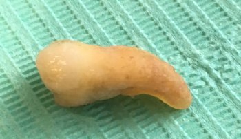 an extracted tooth on a paper surgical mat