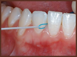 A blue dental floss threader being used to thread flossbetween teeth.
