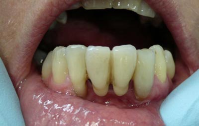 Close-up view of lower incisor teeth with receding gums Close-up view of lower incisor teeth with receding gums