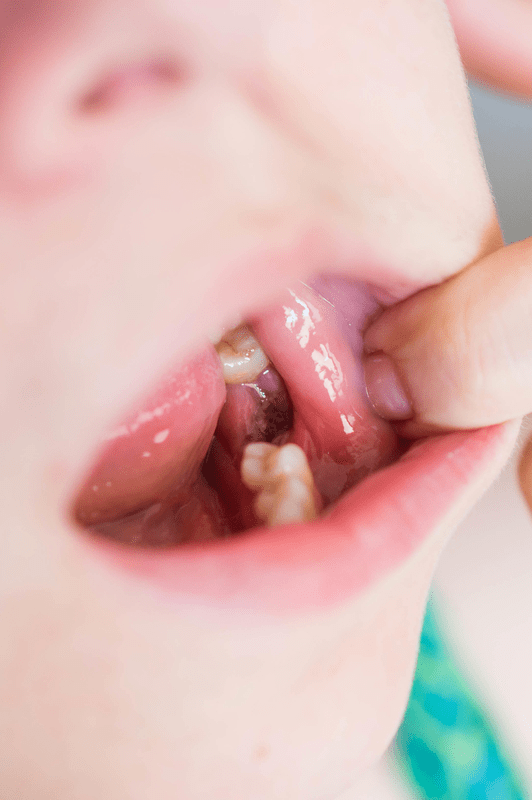 An infection in the gum after a tooth extraction