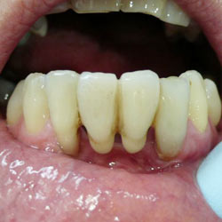 The lower front teeth of a person with gum disease The lower front teeth of a person with gum disease