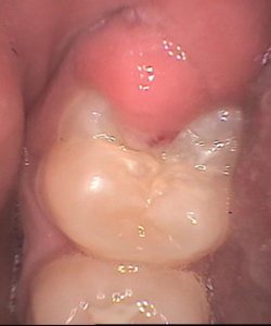a close-up image of a gum flap over a lower wisdom tooth. a close-up image of a gum flap over a lower wisdom tooth.