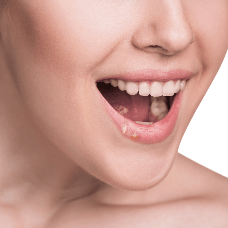 Side-by-side herpes sores on a woman's lower lip Side-by-side herpes sores on a woman's lower lip