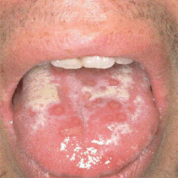 A man's tongue covered with Herpes lesions. A man's tongue covered with Herpes lesions.