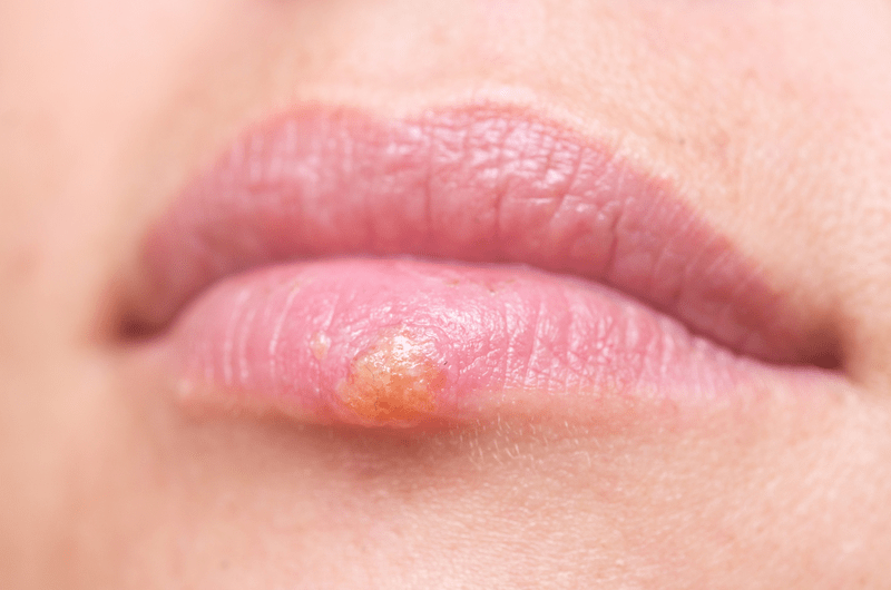 Close up of a herpes sore on a lower lip Close up of a herpes sore on a lower lip