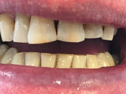 Upper front teeth after composite bonding