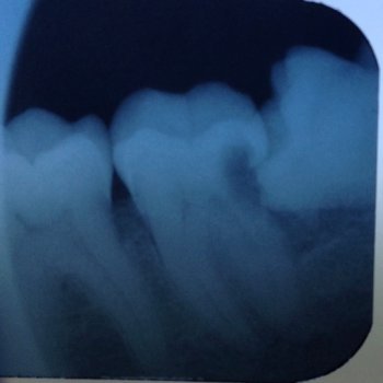 An X ray of a wisdom tooth tilted forwards, growing into the next tooth and causing a cavity.