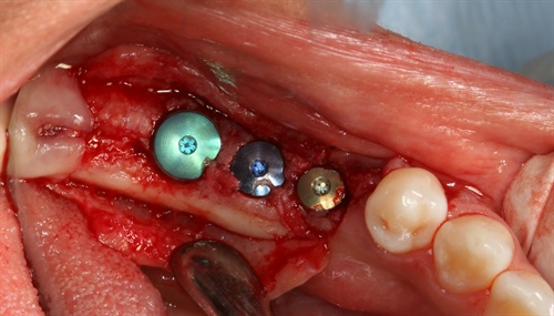 A close-up of three dental implants with healing caps on the lower left jaw