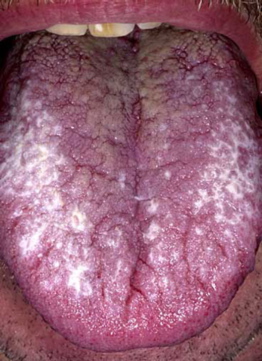Oral hairy Leukoplakia - white patches on the tongue Oral hairy Leukoplakia - white patches on the tongue