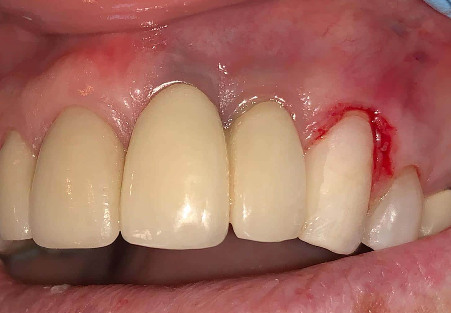 Metal implant showing grey under the gum