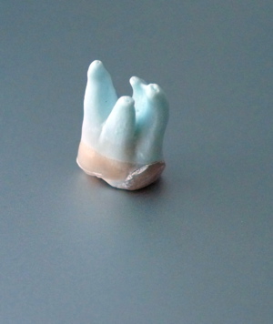 an extracted molar showing the complicated root structure an extracted molar showing the complicated root structure