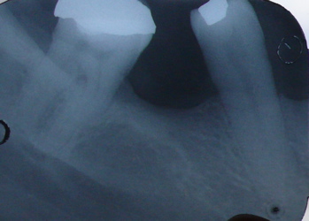 an X-ray of a molar tooth - before root canal treatment an X-ray of a molar tooth - before root canal treatment