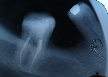 an X-ray of a molar tooth - after root canal treatment an X-ray of a molar tooth - after root canal treatment