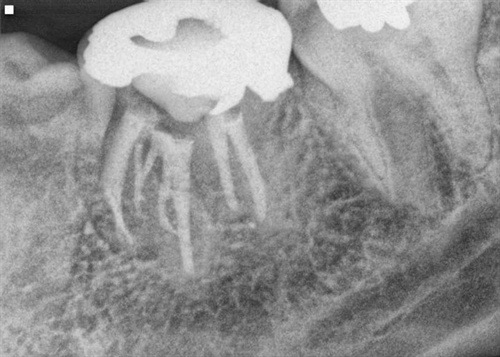 An X-Ray of a lower molar tooth with seven root canals.
