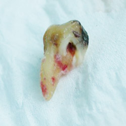 An extracted molar with a broken root on a white gauze background