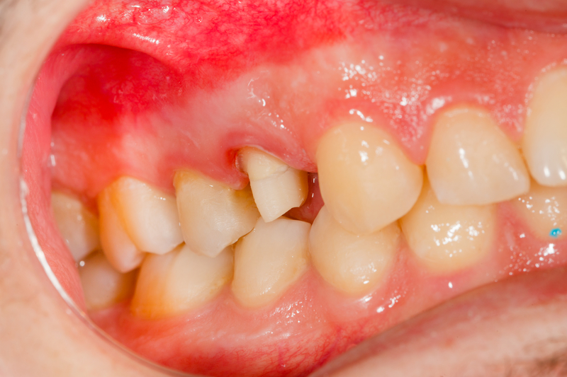 Tooth Pain After Crown Should You Be Worried? What's Wrong?