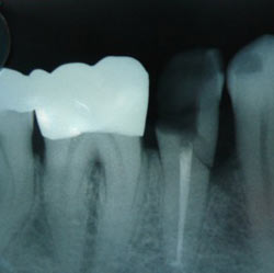 A dental X-ray of a broken tooth