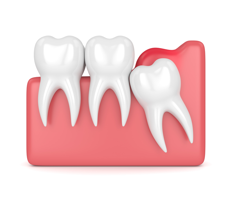 A diagram of how a wisdom tooth is positioned when it is impacted. A diagram of how a wisdom tooth is positioned when it is impacted.