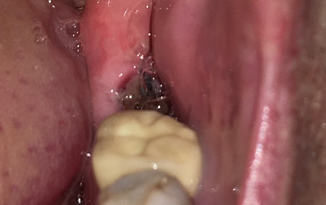 A hole in the lower gum where a molar has been extracted A hole in the lower gum where a molar has been extracted