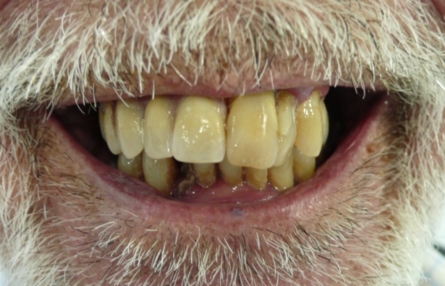 Close up of a man's teeth after getting new dentures. Close up of a man's teeth after getting new dentures.