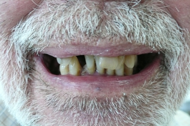 Close up of a mans broken down front teeth, with a grey mustache and beard. Close up of a mans broken down front teeth, with a grey mustache and beard.