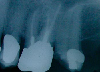 An X ray picture of an upper molar tooth with a root filling and a crown