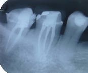 An X-Ray of two molar teeth with white lines in the roots, indicating root fillings.