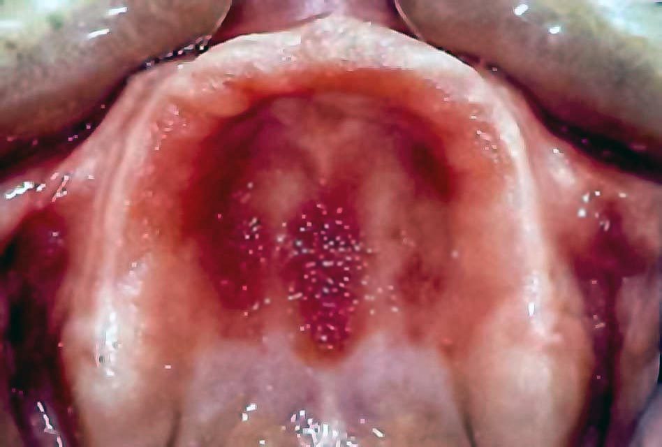 Stomatitis of the mouth on the hard palate Stomatitis of the mouth on the hard palate
