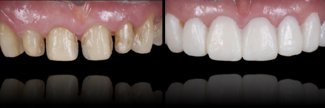 Before and after photos of teeth that have been prepared for veneers