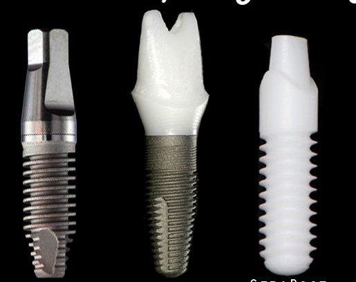 Titanium implant and abutment on the right; Titanium implant and ceramic abutment in the middle; and a Zirconia implant on the right