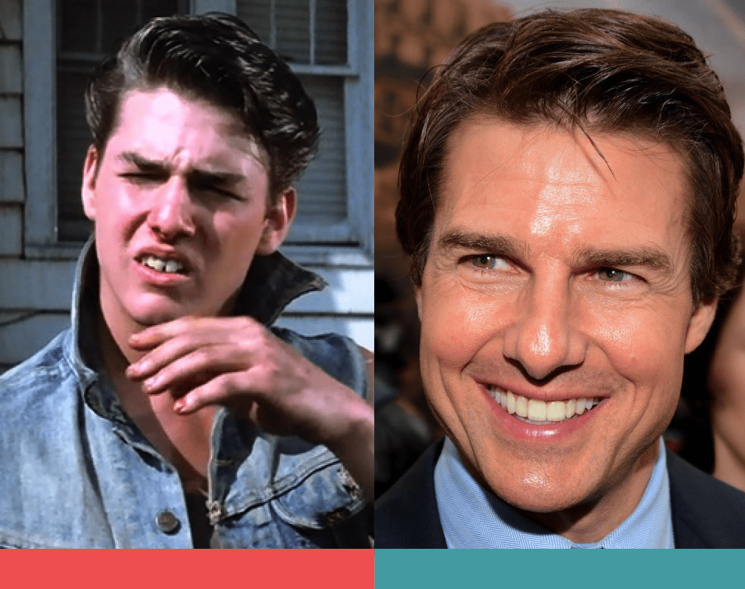 Tom Cruise' bad teeth before-and-after photos.