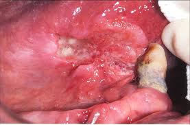 Close-up view of a tongue cancer Close-up view of a tongue cancer