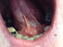 White patch under the tongue which is cancer