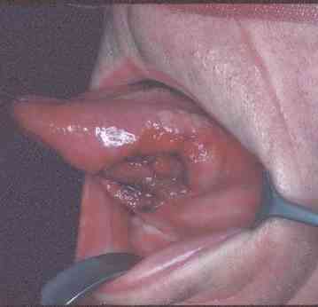 Close-up view of a tongue cancer Close-up view of a tongue cancer