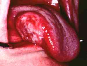 Close-up view of a tongue cancer Close-up view of a tongue cancer