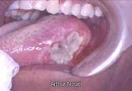 Close-up view of a tongue cancer