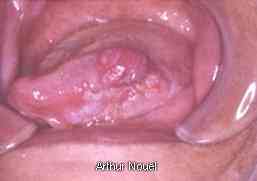 Close-up view of a tongue cancer