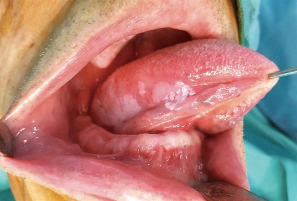 Close-up view of a tongue cancer Close-up view of a tongue cancer