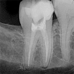 An X-ray image of a lower molar tooth with a white filling visible in each root.