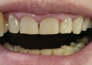 close-up view of worn down upper front teeth