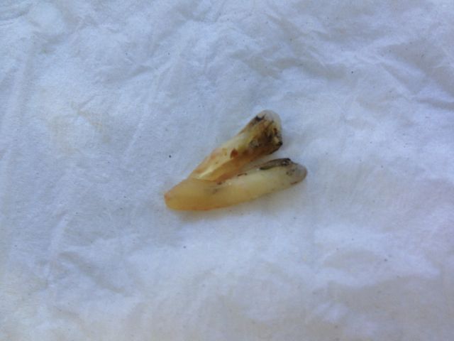 An extracted premolar tooth on a white background, pulled apart to demonstrate the fracture through the root. An extracted premolar tooth on a white background, pulled apart to demonstrate the fracture through the root.