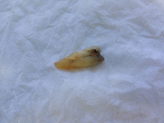 An extracted premolar tooth on a white background with a fine crack through the root An extracted premolar tooth on a white background with a fine crack through the root