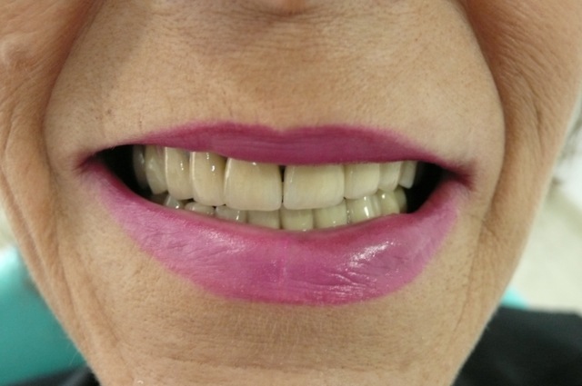 Close up of a woman's teeth after getting new dentures. Close up of a woman's teeth after getting new dentures.