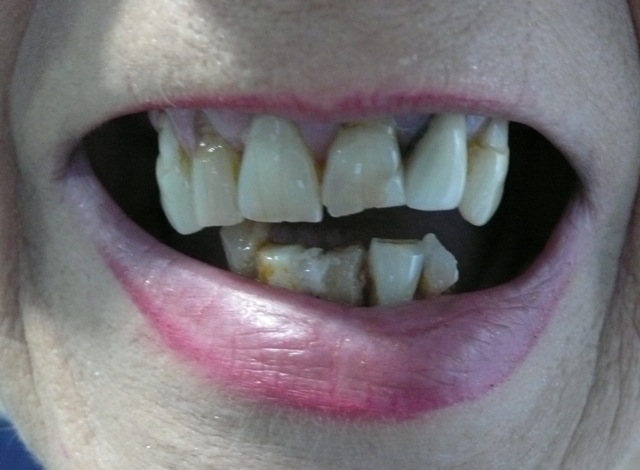 Close up of a womans bad teeth, with a drooping lower lip. Close up of a womans bad teeth, with a drooping lower lip.