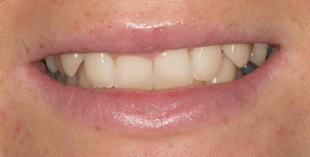 crooked upper front teeth