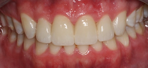 dental veneers before and after