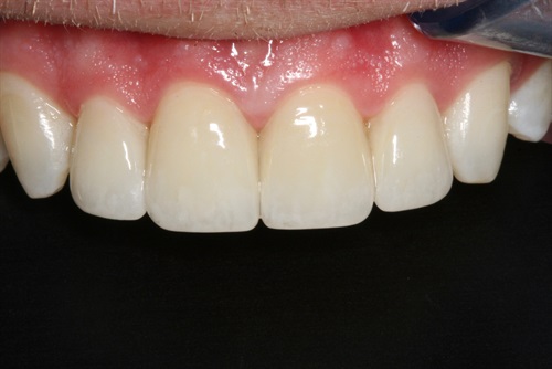 dental veneers before and after