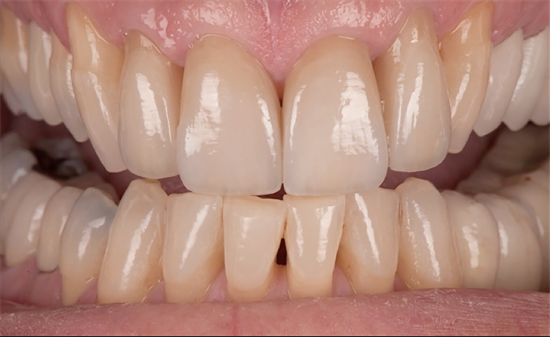 dental veneers before and after