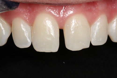 dental veneers before and after