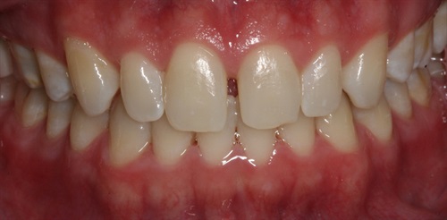 dental veneers before and after